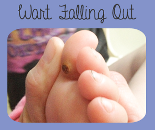 how-do-plantar-warts-fall-off